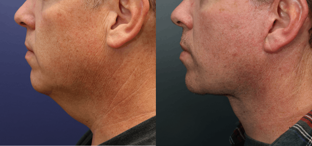 Deep Plane Neck Lift Before & After Gallery - Patient 136724 - Image 5