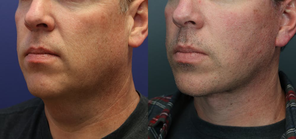 Deep Plane Neck Lift Before & After Gallery - Patient 136724 - Image 4