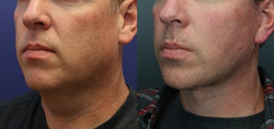 Deep Plane Neck Lift Before & After Gallery - Patient 136724 - Image 4
