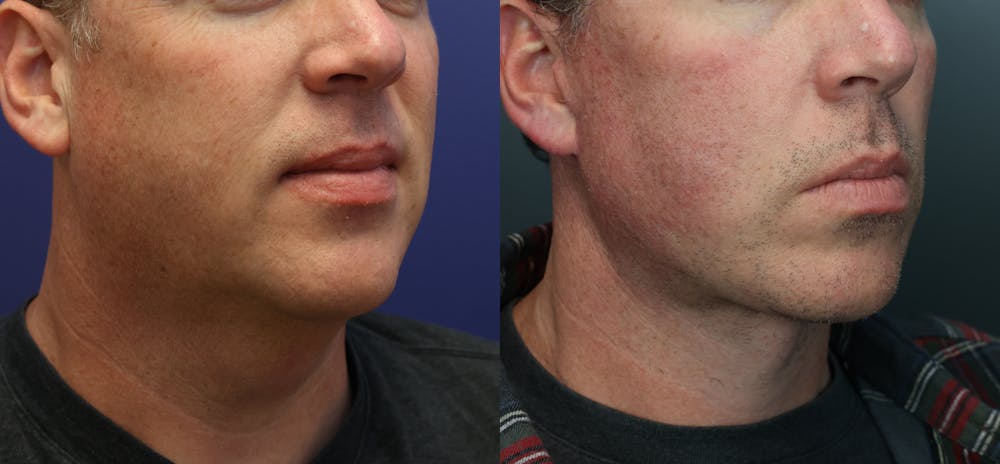 Deep Plane Neck Lift Before & After Gallery - Patient 136724 - Image 1