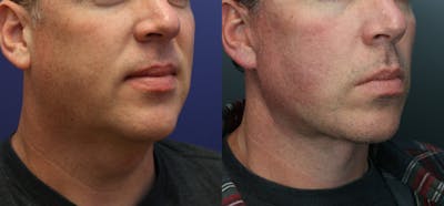 Deep Plane Neck Lift Before & After Gallery - Patient 136724 - Image 1