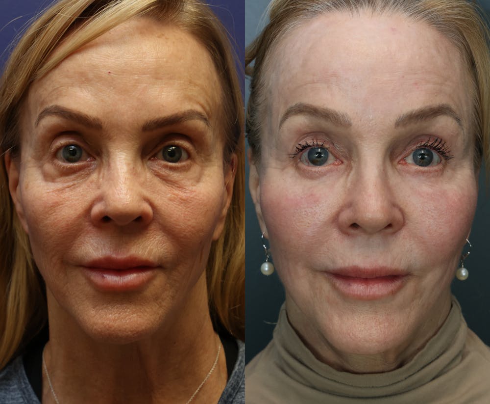 CO2 Laser Resurfacing Before & After Gallery - Patient 338599 - Image 1