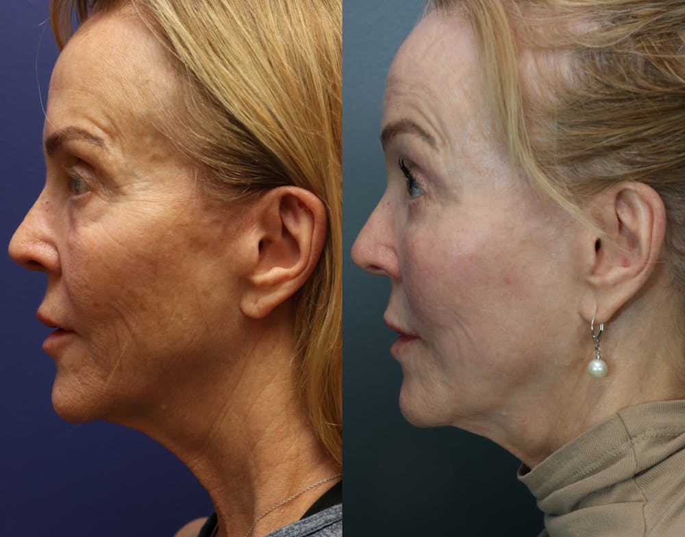 CO2 Laser Resurfacing Before & After Gallery - Patient 338599 - Image 5