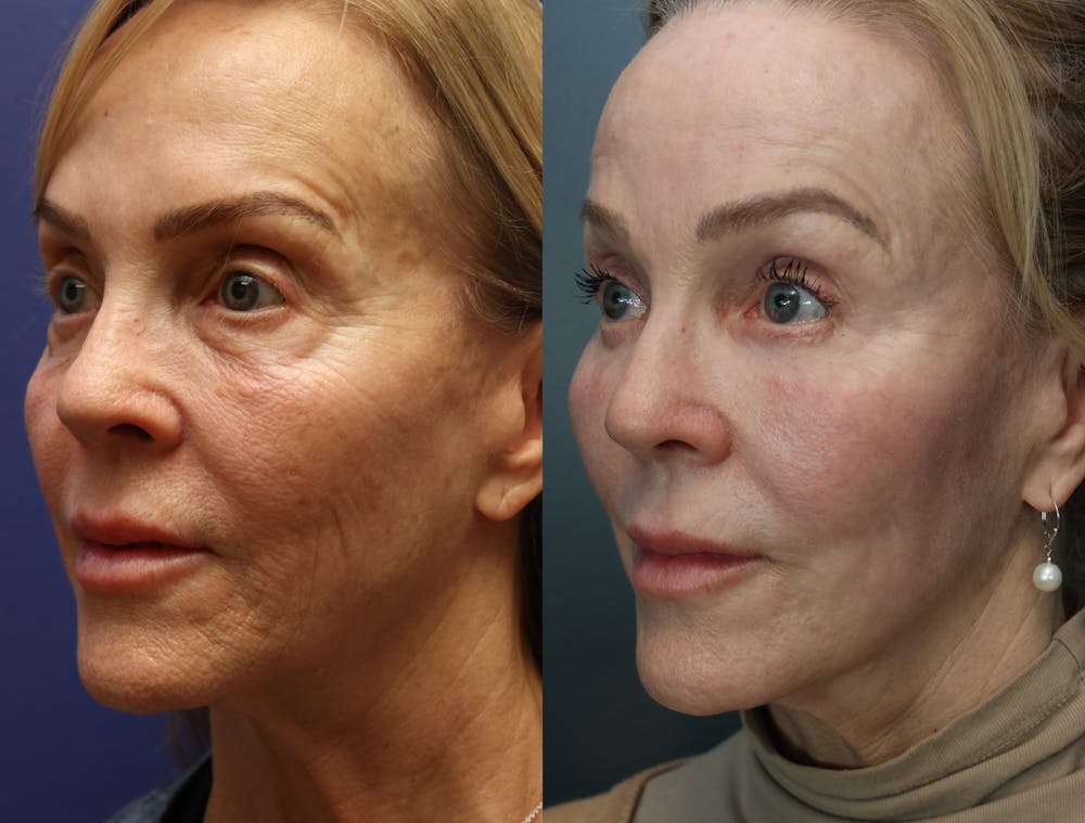 Facial Revolumizing (Fat Transfer) Before & After Gallery - Patient 872368 - Image 4