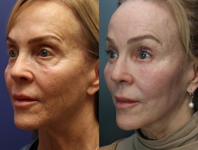 CO2 Laser Resurfacing Before & After Gallery - Patient 338599 - Image 4