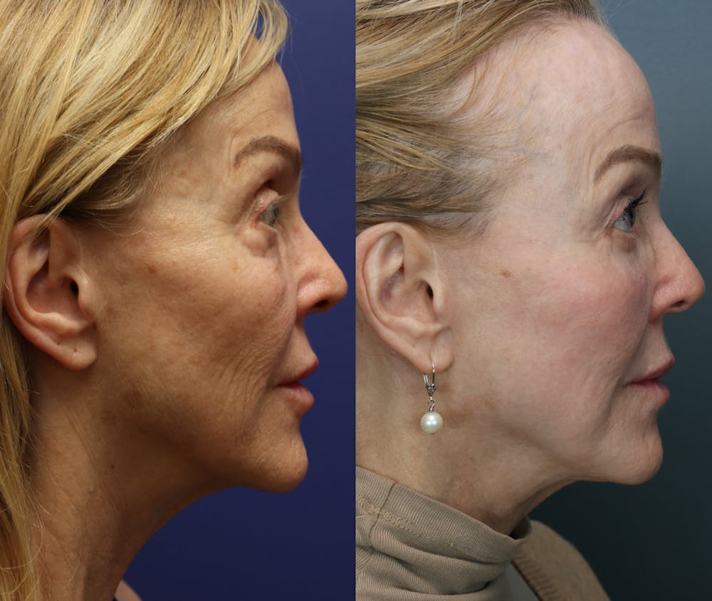 Facial Revolumizing (Fat Transfer) Before & After Gallery - Patient 872368 - Image 3
