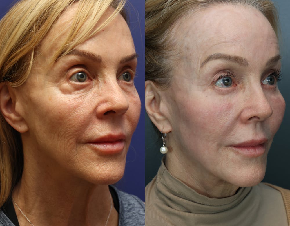 CO2 Laser Resurfacing Before & After Gallery - Patient 338599 - Image 2