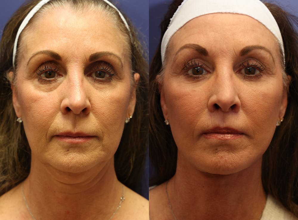 Deep Plane Neck Lift Before & After Gallery - Patient 652176 - Image 2