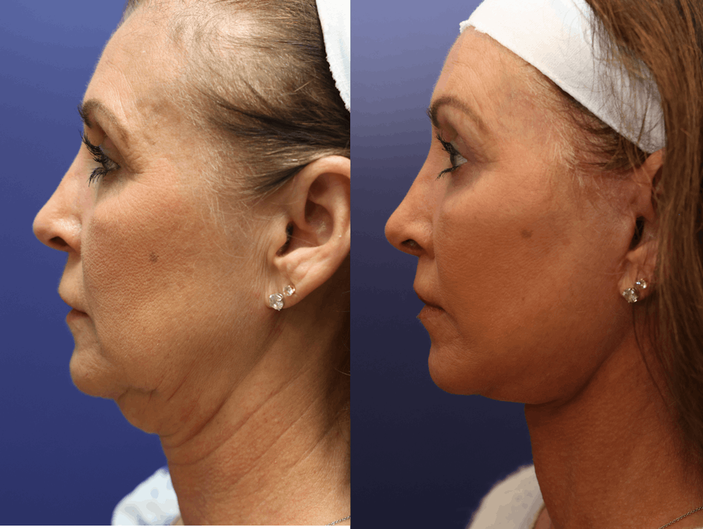 Facial Revolumizing (Fat Transfer) Before & After Gallery - Patient 356192 - Image 5