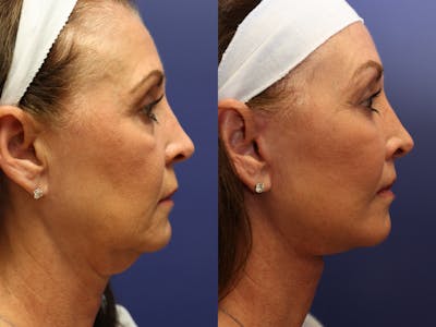 Deep Plane Facelift Before & After Gallery - Patient 112970 - Image 4