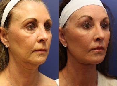 Deep Plane Neck Lift Before & After Gallery - Patient 652176 - Image 1