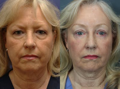 Brow Lift (Forehead Lift) Before & After Gallery - Patient 182710 - Image 1