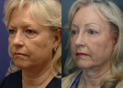 Brow Lift (Forehead Lift) Before & After Gallery - Patient 182710 - Image 2