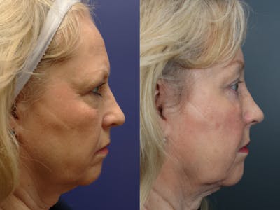 Eyelid Surgery Before & After Gallery - Patient 311497 - Image 4