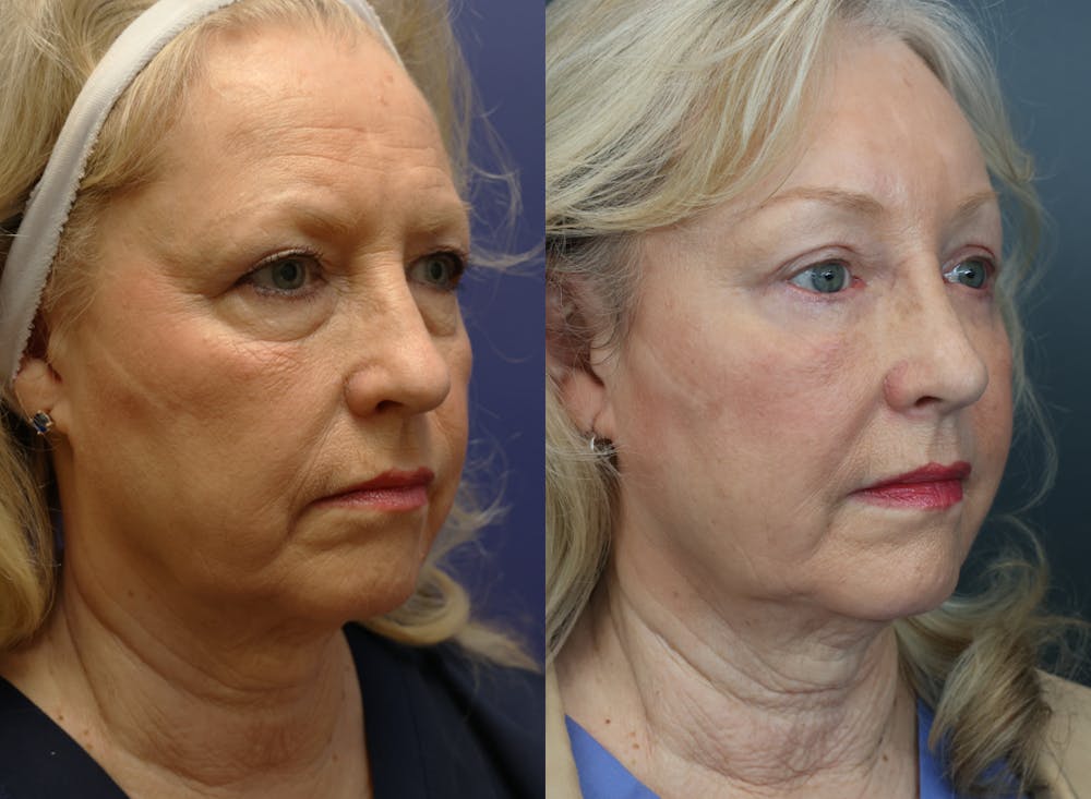 Brow Lift (Forehead Lift) Before & After Gallery - Patient 182710 - Image 3