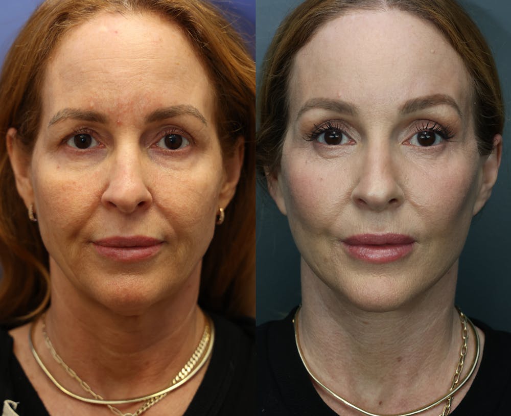 Brow Lift (Forehead Lift) Before & After Gallery - Patient 120358 - Image 1