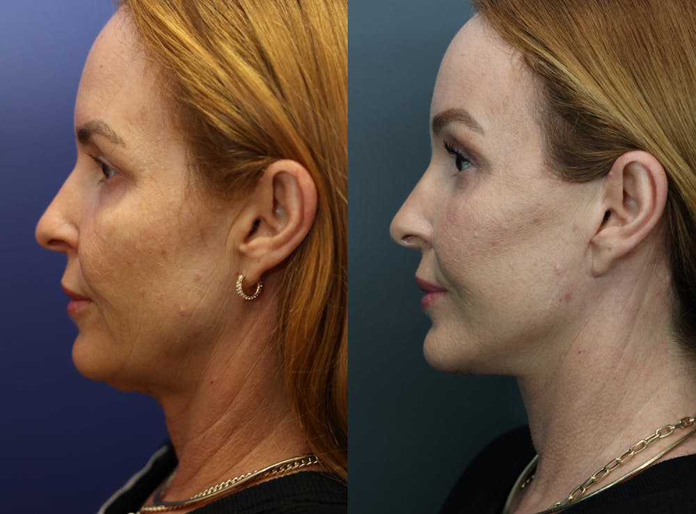 Deep Plane Neck Lift Before & After Gallery - Patient 280827 - Image 5