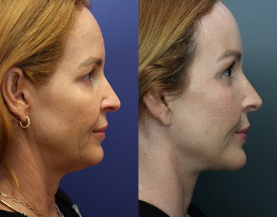 Facial Revolumizing (Fat Transfer) Before & After Gallery - Patient 201453 - Image 4