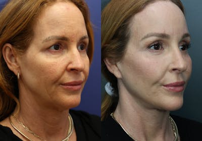 Facial Revolumizing (Fat Transfer) Before & After Gallery - Patient 201453 - Image 2