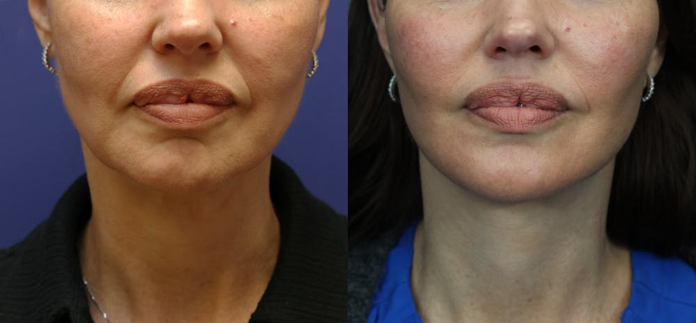 Deep Plane Facelift Before & After Gallery - Patient 566771 - Image 3