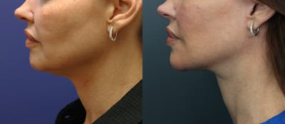 Deep Plane Facelift Before & After Gallery - Patient 566771 - Image 4