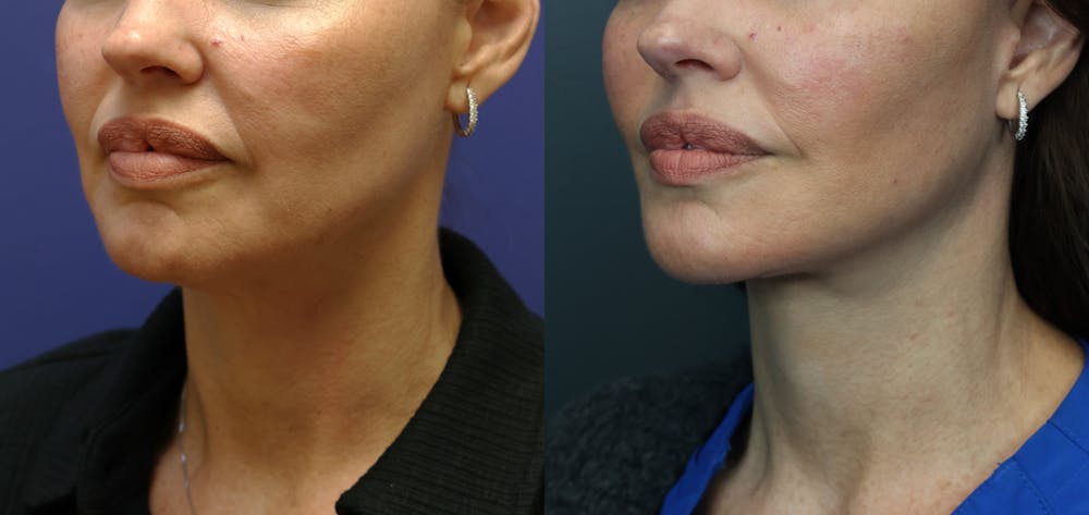 Deep Plane Neck Lift Before & After Gallery - Patient 156274 - Image 1