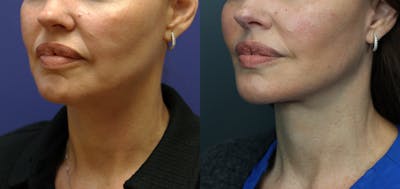 Deep Plane Neck Lift Before & After Gallery - Patient 156274 - Image 1