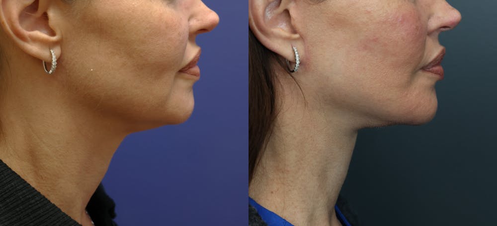 Deep Plane Neck Lift Before & After Gallery - Patient 156274 - Image 5