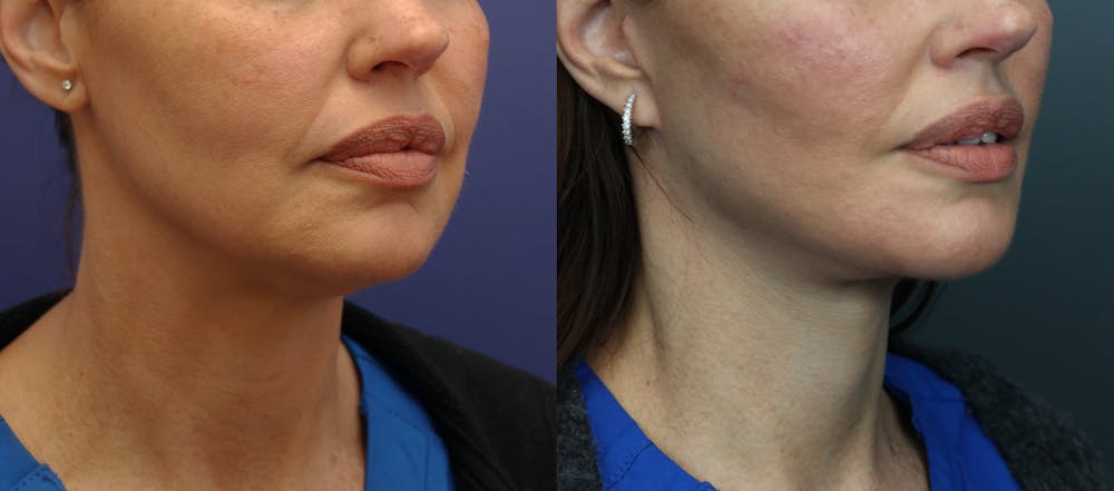 Deep Plane Neck Lift Before & After Gallery - Patient 156274 - Image 2