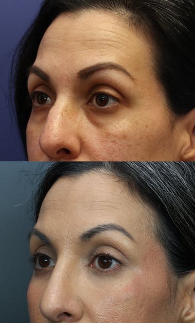 Eyelid Surgery Before & After Gallery - Patient 649503 - Image 1