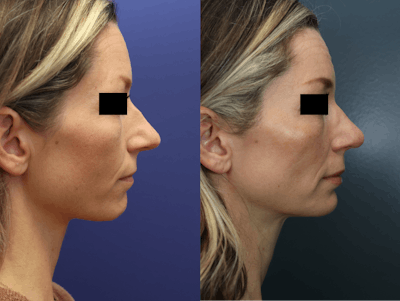 Rhinoplasty (Nose Reshaping) Before & After Gallery - Patient 178920 - Image 4