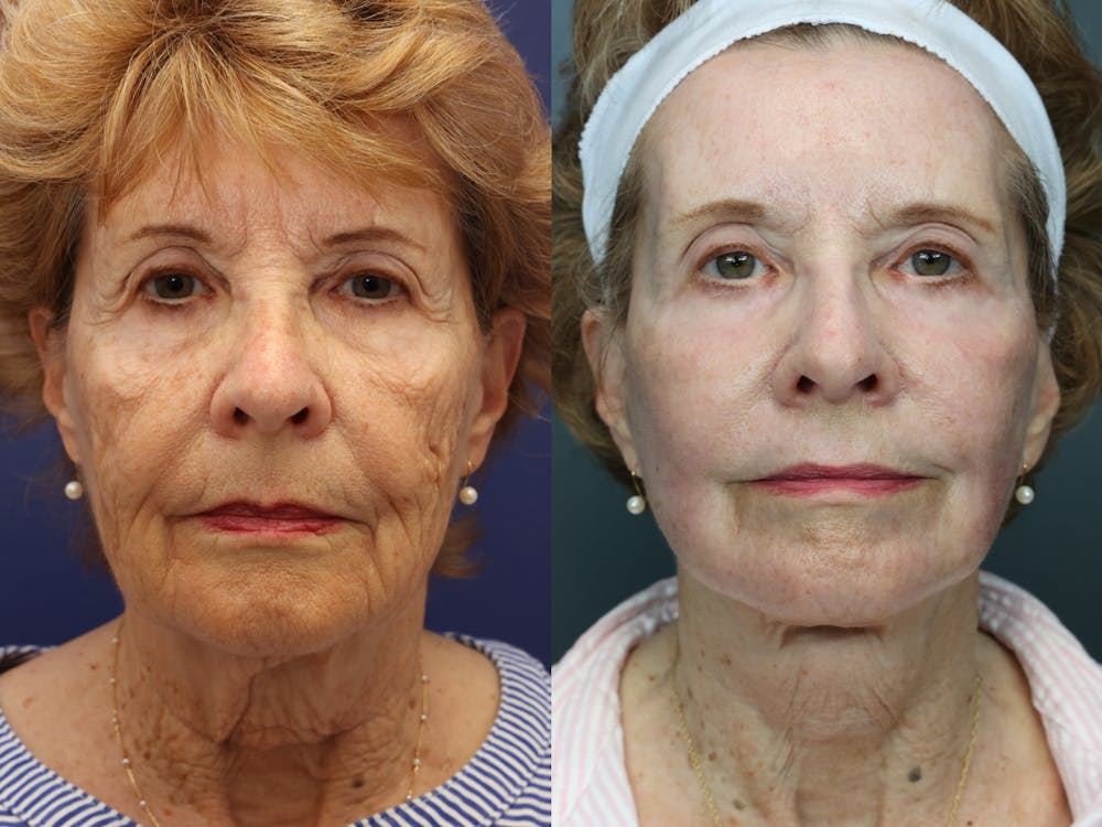 Deep Plane Facelift Before & After Gallery - Patient 188730 - Image 4