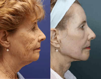 CO2 Laser Resurfacing Before & After Gallery - Patient 311563 - Image 4