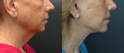 Deep Plane Facelift Before & After Gallery - Patient 292911 - Image 4