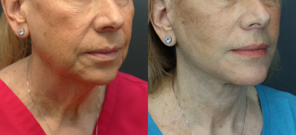 Deep Plane Facelift Before & After Gallery - Patient 292911 - Image 5