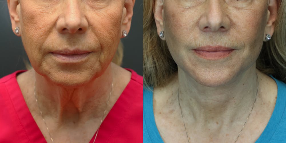 Deep Plane Facelift Before & After Gallery - Patient 292911 - Image 2