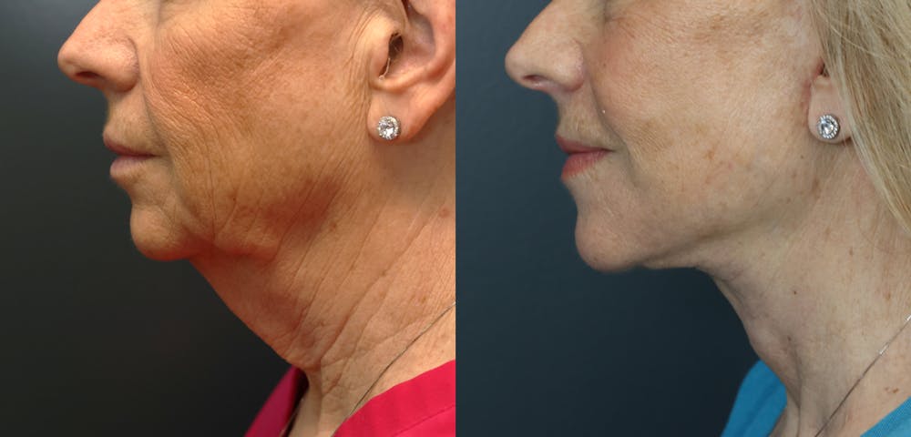 Deep Plane Facelift Before & After Gallery - Patient 292911 - Image 3