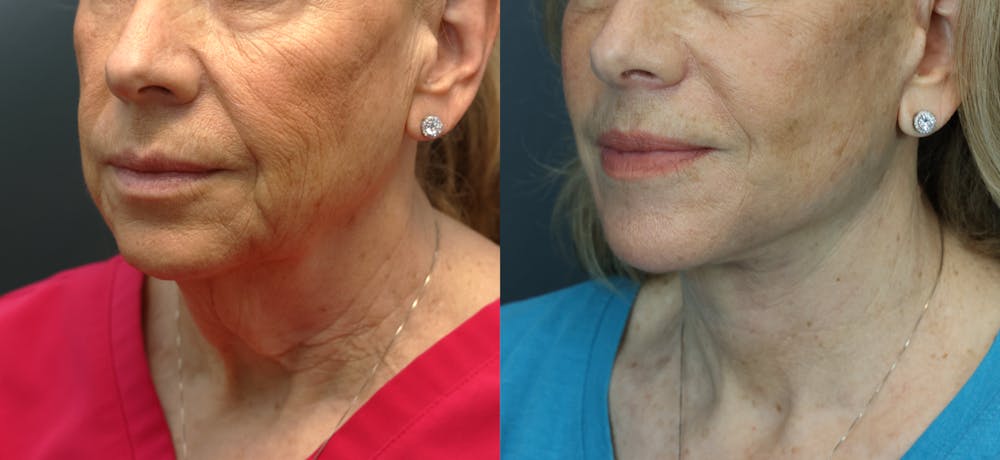 Deep Plane Facelift Before & After Gallery - Patient 292911 - Image 1