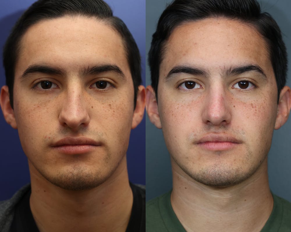 Rhinoplasty (Nose Reshaping) Before & After Gallery - Patient 116162 - Image 3