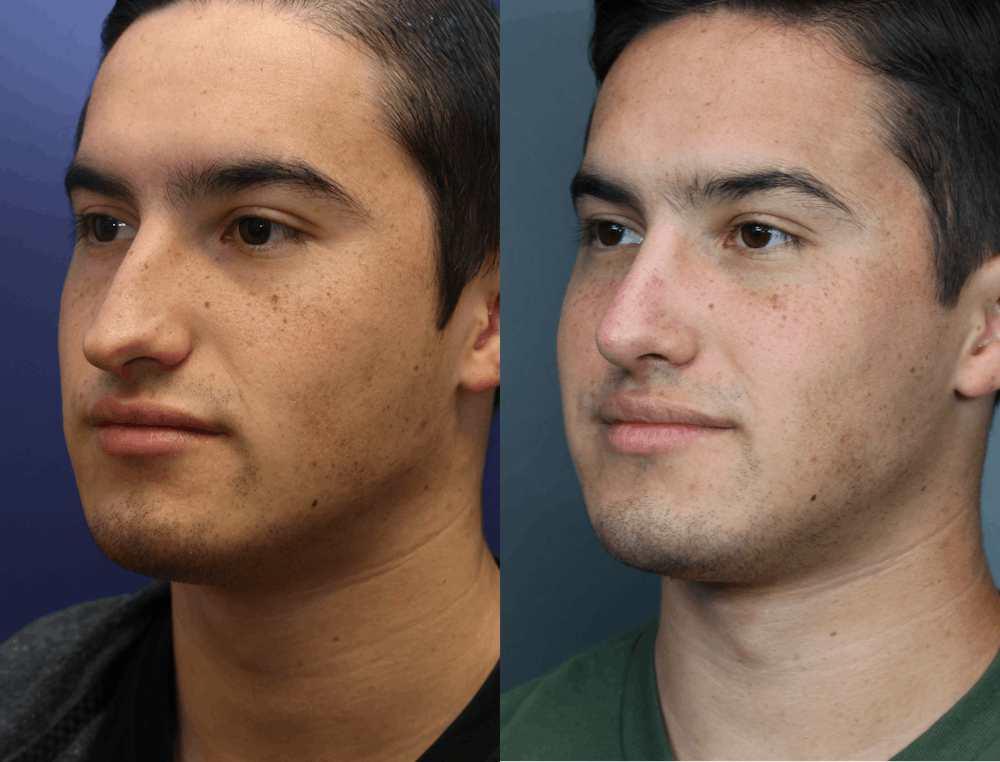 Rhinoplasty (Nose Reshaping) Before & After Gallery - Patient 116162 - Image 2
