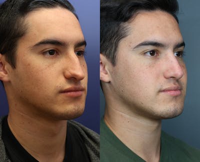 Rhinoplasty (Nose Reshaping) Before & After Gallery - Patient 116162 - Image 1