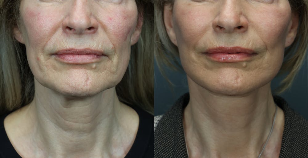 Deep Plane Facelift Before & After Gallery - Patient 516212 - Image 3