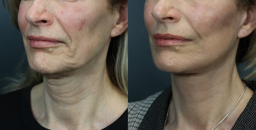 Deep Plane Facelift Before & After Gallery - Patient 516212 - Image 2