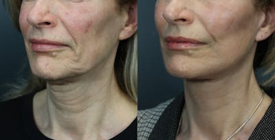 Deep Plane Facelift Before & After Gallery - Patient 516212 - Image 2