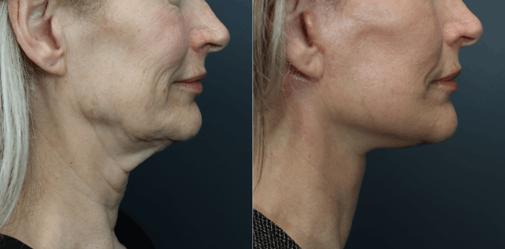 Deep Plane Facelift Before & After Gallery - Patient 516212 - Image 5