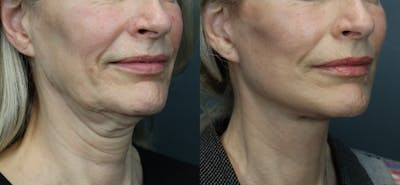 Deep Plane Neck Lift Before & After Gallery - Patient 270496 - Image 1