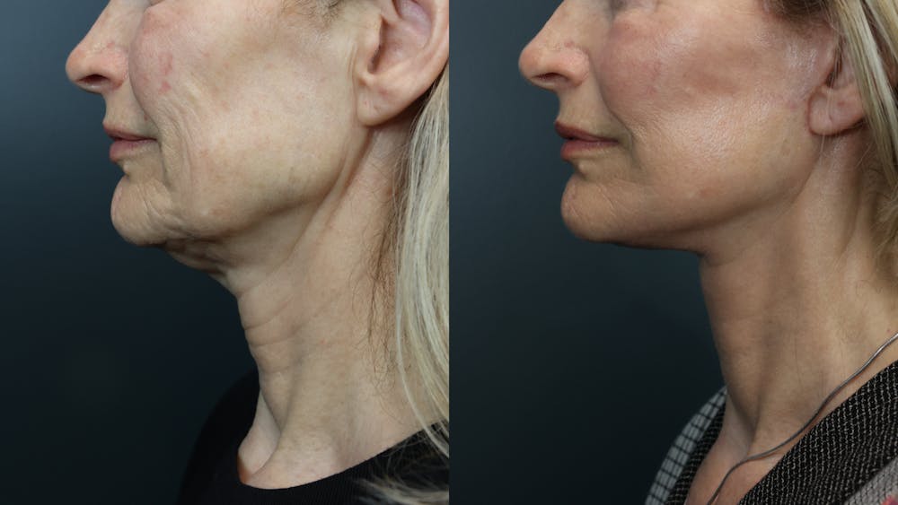 Deep Plane Facelift Before & After Gallery - Patient 516212 - Image 4