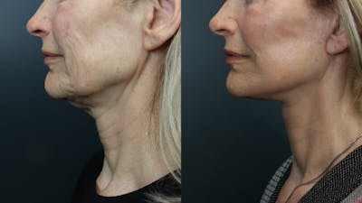 Deep Plane Facelift Before & After Gallery - Patient 516212 - Image 4