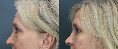 Eyelid Surgery Before & After Gallery - Patient 504225 - Image 4