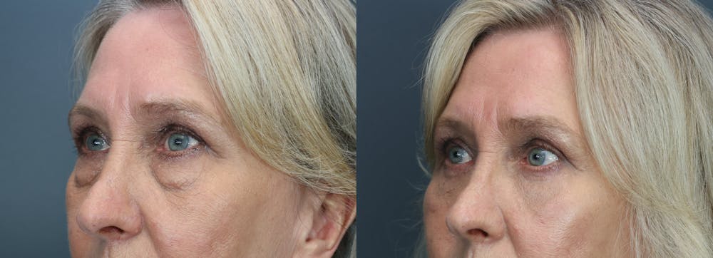 Eyelid Surgery Before & After Gallery - Patient 504225 - Image 2